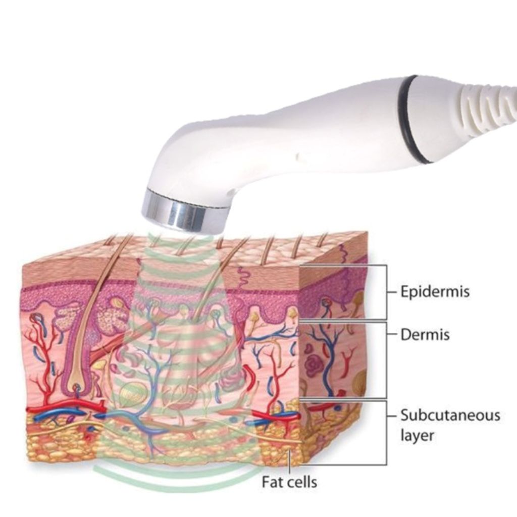 Ultrasound Therapy Treatment
